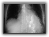 Ruptured esophagus-039