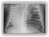 Cystic adenomatoid malformation-021