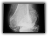 Charcot-knee-033