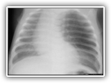 Congenital Lobar Emphysema-026