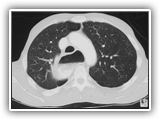 Achalasia-100