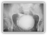 Bladder rupture-extraperitoneal-101