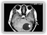 Hemangioblastoma-110