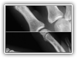 Volar plate fracture-111