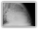 Pericardial effusion-lateral chest