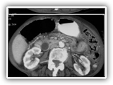 Mesenteric ischemia-113