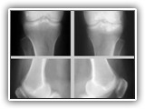 Pre-patellar bursitis-Housemaid's knee-116