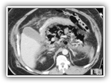 Emphysematous pancreatitis-117