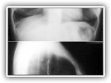 Aortic stenosis-118