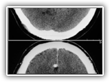 Arteriovenous malformation-119