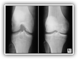 Osteochondritis dissecans-120