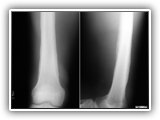 Hypertrophic osteoarthropathy-121