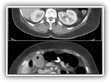 Gas in gallstones-124