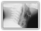 Perforated pharynx-126