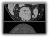 Lipohemarthrosis-127