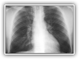 Coarctation of aorta-128