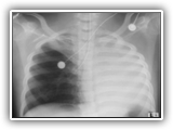 Atelectasis of left lung-129