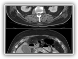 Emphysematous cholecystitis-131