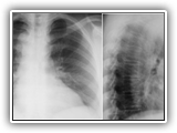 Right aortic arch-133