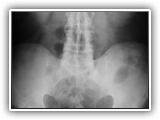 Ankylosing spondylitis-134