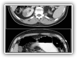 Renal infarct-135