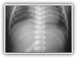 Esophageal atresia-137