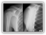 Acromioclavicular separation-138