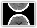 Choroid plexus cysts-145