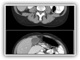 Sup. mesenteric artery syndrome-147