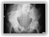 Osteosarcoma in Paget disease-149