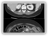 Gallstone ileus-150