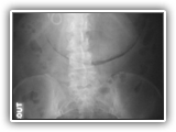 Gastric emphysema-034