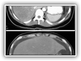 Budd-Chiari Syndrome-045