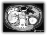 Acute pyelonephritis-62