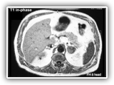 Adrenal adenoma-066