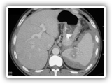 Splenic laceration-068