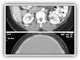 Serous cystadenoma of ovary-069