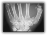 Rolando fracture-070