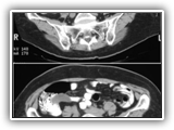 Mucocele of appendix-073