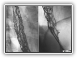 Candidiasis-084