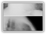 Pericardial calcification-090