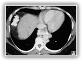 Esophageal varices-091