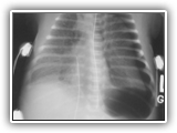 Hyaline membrane disease-092