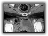 Intussusception-093