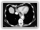 Penetrating aortic ulcer-094