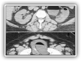 Emphysematous pyelonephritis-095