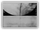 Transitional cell ca of ureter-097