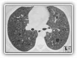 Lymphangiomyomatosis-098