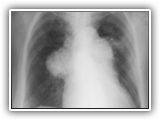 Pulmonary arterial hypertension-099