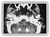 Fahrs disease-018